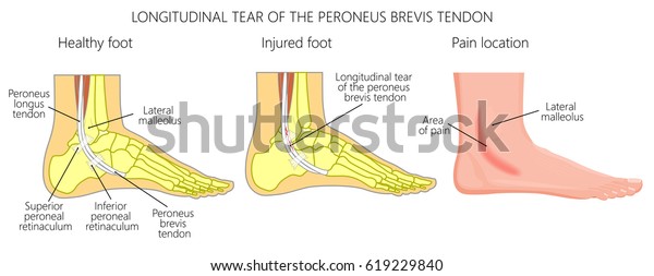 Vector Illustration Peroneal Tendon Injuries Longitudinal Stock Vector ...