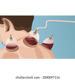 vector illustration A person is doing therapy with a vacuum cup on the patient's back. Cupping is an alternative medicine, where local suction is applied to the skin. sucking dirty blood in the body