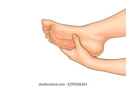 Vector illustration of pitted keratolysis on foot,bacterial infection that affects skin,fungal,odor,itchiness,small hole footwear,sore warts deep,isolated on white.Health care,Skin care feet.