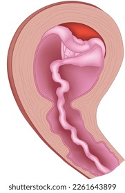 Vector illustration of placental abruption and expulsion.