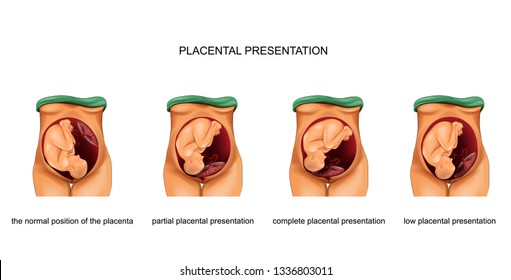 vector illustration of placental presentation norm and pathology