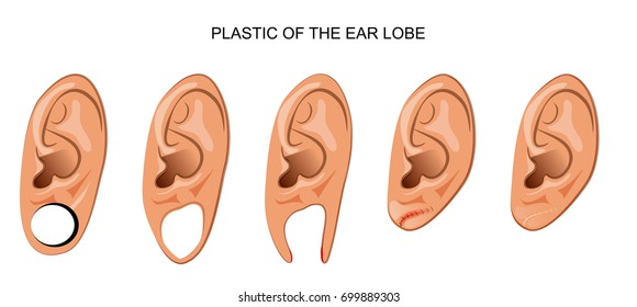 vector illustration of a plastic ear after ear tunnel
