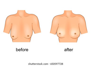 vector illustration of plastic surgery of the breast. before and after