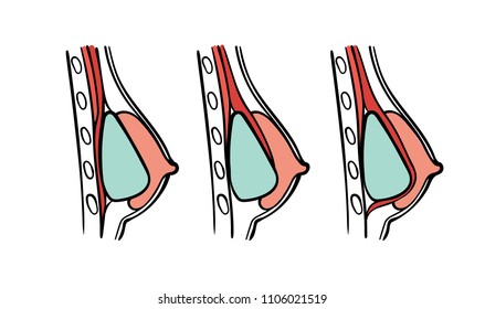 Vector illustration of plastic surgery types - breast implants positions chart: submuscular, subglandular and subfacial implantology.