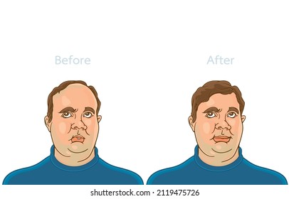 Vector illustration of plump middle aged man concerned with hair loss problem,alopecia,front view, before,after hair extensions,hair transplant surgery,on white,Healthy hair,Losing hair become shaggy.