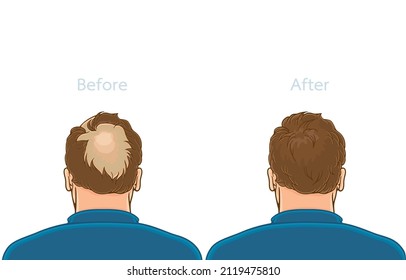 Vector illustration of plump middle aged man concerned with hair loss problem,alopecia,back view, before,after hair extensions,hair transplant surgery,on white,Healthy hair,Losing hair become shaggy.