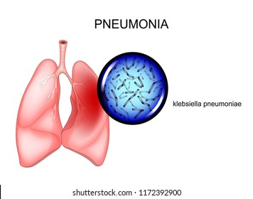 vector illustration of pneumonia. causative agent - Klebsiella