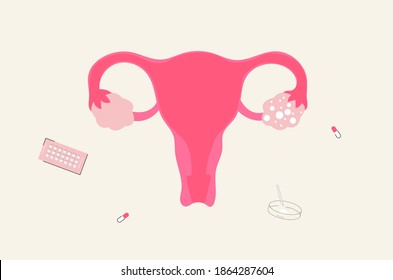 Vector Illustration Of Polycystic Ovary Syndrome Or PCOS