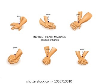 vector illustration of the position of the doctor's hands in indirect heart massage