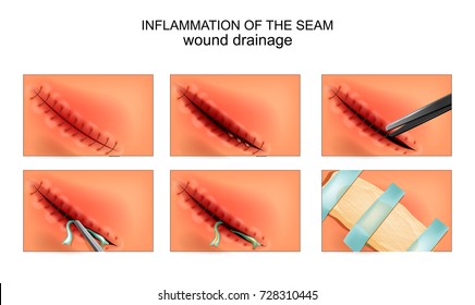 vector illustration of a postoperative inflammation of the joint. wound drainage
