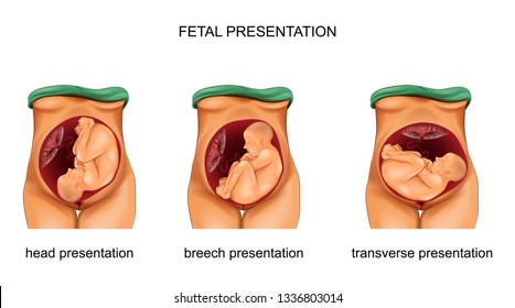 vector illustration of a presentation of the fetus. norm and pathology