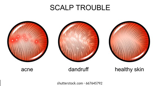 vector illustration of a problematic scalp. dermatology
