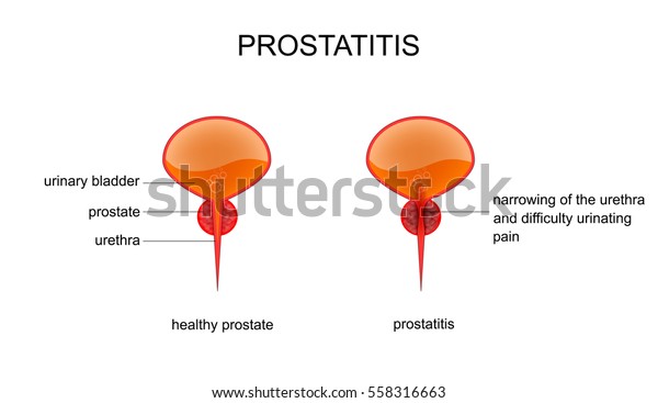 Vector Illustration Problems Andrology Publication Medical Stock Vector ...