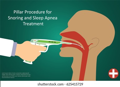 Vector illustration of procedures for sleep apnea pillar operation.