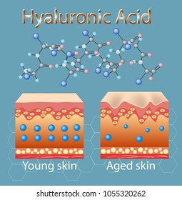 Vector illustration with process of getting skin old because of lack of hyaluronic acid