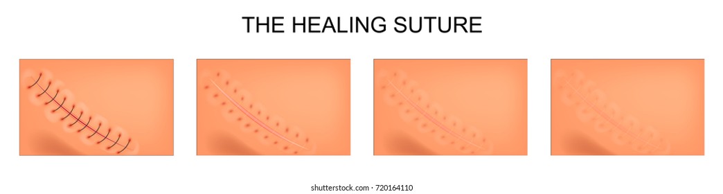 vector illustration of the process of healing of postoperative suture
