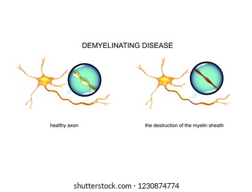 vector illustration of the process of nerve fiber destruction