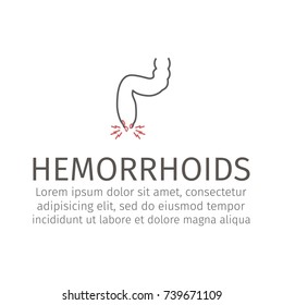 vector illustration of a prolapsed hemorrhoid veins