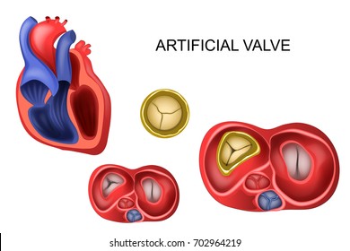 Vector Illustration Of A Prosthetic Tricuspid Heart Valve
