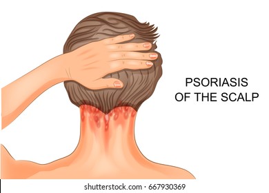 vector illustration of psoriasis of the scalp