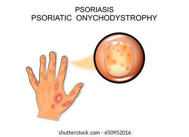 vector illustration of a psoriatic onychodystrophy. psoriasis.