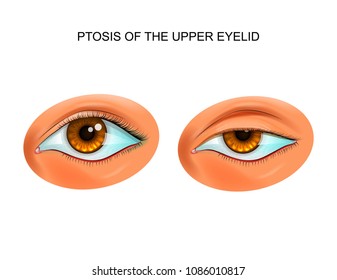 Vector Illustration Of Ptosis Of Eyelid. Paralytic Drooping Of The Eyelid