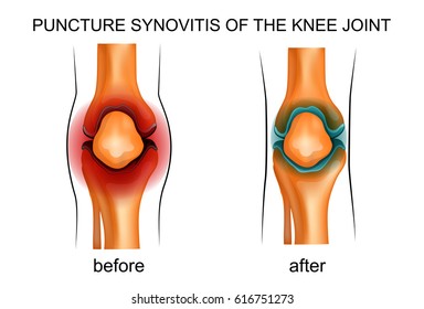 vector illustration of a puncture synovitis of the knee joint
