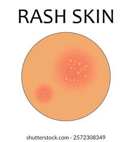 vector illustration of rash skin. Acne, allergy, dermatitis, eczema, skin irritation, itchy, dermatology. Isolated on white background