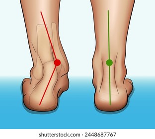 Vector illustration in realistic style depicting the medical problem of foot or ankle curvature or deformity, valgus deformity and flat feet problem.