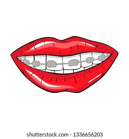 Vector illustration red lip with braces on teeth in comics style. Isolated on white background