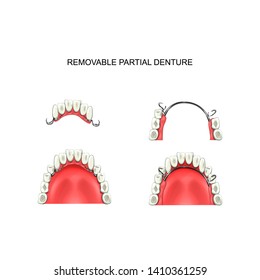 vector illustration of removable partial denture. prosthetics