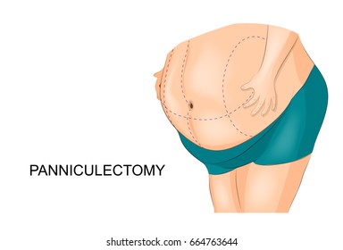 vector illustration of removal of fat apron. panniculectomy
