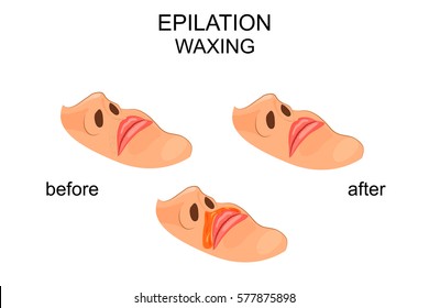 vector illustration of removal of a mustache. waxing in women.

