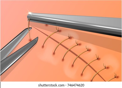 Vector Illustration Of Removal Of Surgical Stitches
