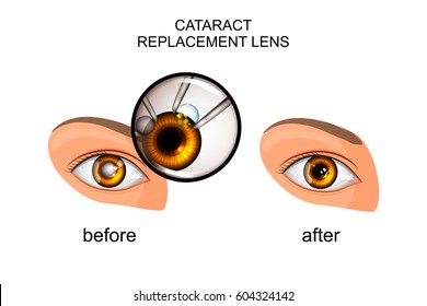 Vector Illustration Of A Replacement Of The Crystalline Lens In Cataract
