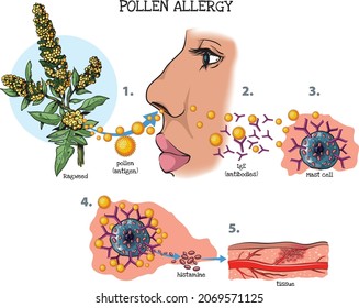 Vector illustration of the response of the immune system to pollen allergy