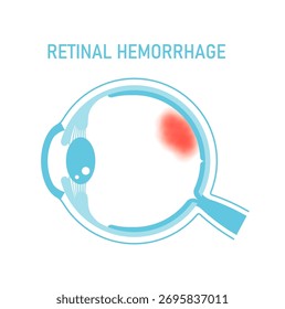 Ilustración vectorial de hemorragia retiniana