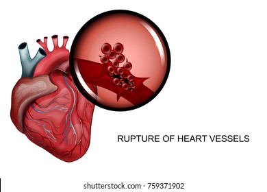 vector illustration of a rupture of the vessels of the heart