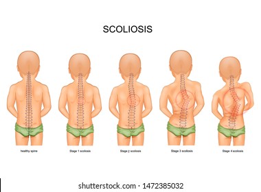 vector illustration of scoliosis stage in children