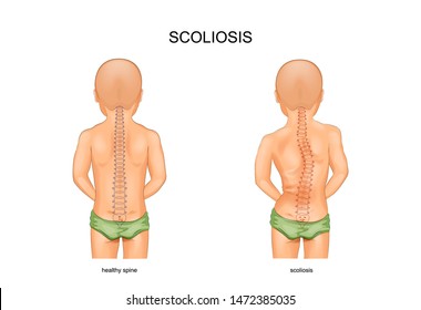 vector illustration of scoliosis stage in children