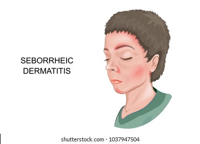 vector illustration of seborrheic dermatitis of the skin