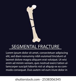 ilustração vetorial de fratura segmentar