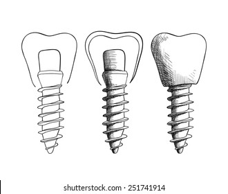 Vector illustration. Set of sketches, dental implants.