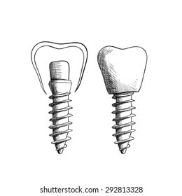 Vector illustration. Set of sketches, dental implants.