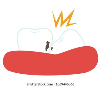 Vector illustration set of teeth. Caries. Dental clinic