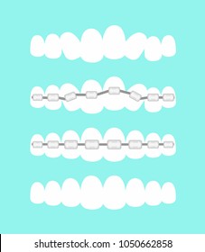 Vector illustration set of teeth, dental orthodontics treatment with teeth braces, process of level teeth, beautiful smile in cartoon flat style.