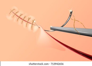 vector illustration of sewing up the wound with surgical needle