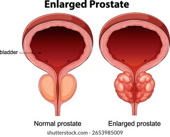 Ilustração vetorial mostrando diferenças anatômicas entre próstata normal e aumentada. Rotulagem clara e visão transversal detalhada