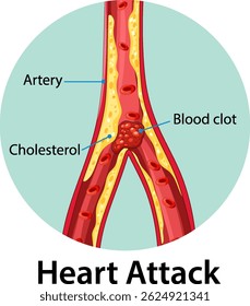 Ilustração vetorial mostrando bloqueio arterial por colesterol e coágulo sanguíneo, destacando o risco de ataque cardíaco. Diagrama médico detalhado com rótulos