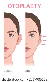 Vector illustration showing before and after otoplasty. Diagram of ear correction can be used for advertising and educational purposes in aesthetic medicine.